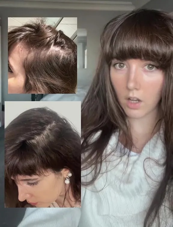 Sofía tiene el pelo calvo.