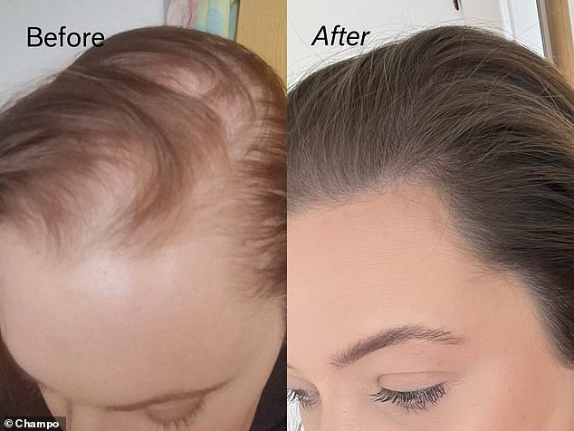 Antes y después: para obtener una solución altamente eficaz que proporcione un cabello más grueso, abundante y fuerte, muchos han recurrido al Champo Pitta Growth Serum.