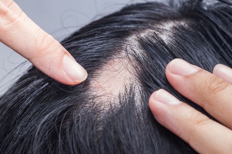 Recomendación clínica NICE para la alopecia areata